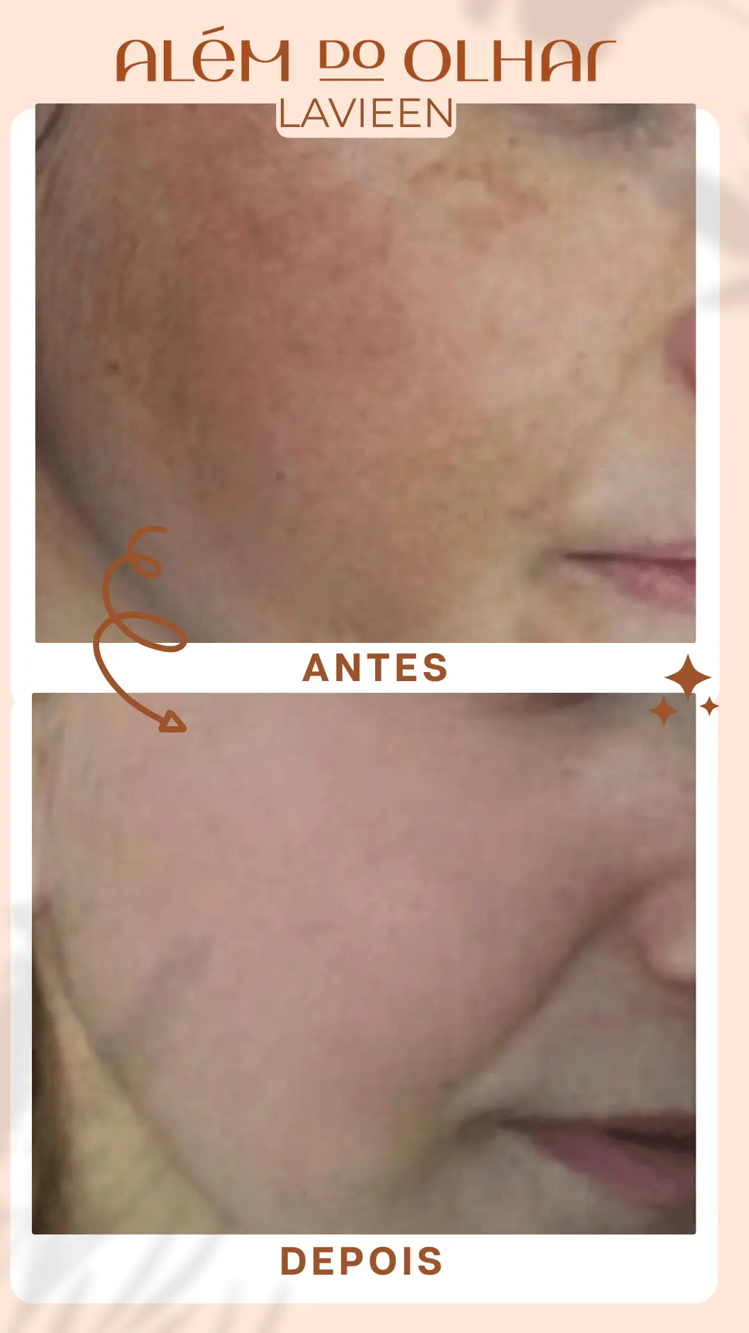 Rejuvenesça, trate manchas e melhore a textura da sua pele com o Lavieen — o "laser BB Glow" coreano que entrega resultados visíveis e seguros.
