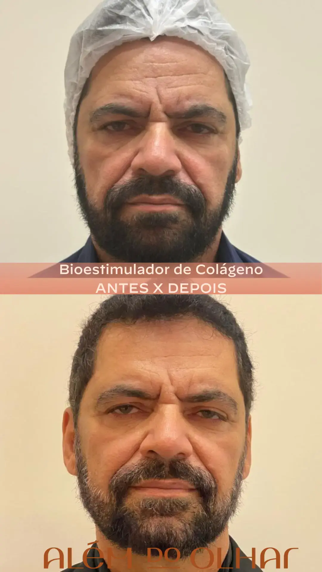 Aplicação de bioestimulador de colágeno na clínica Além do Olhar em Atibaia