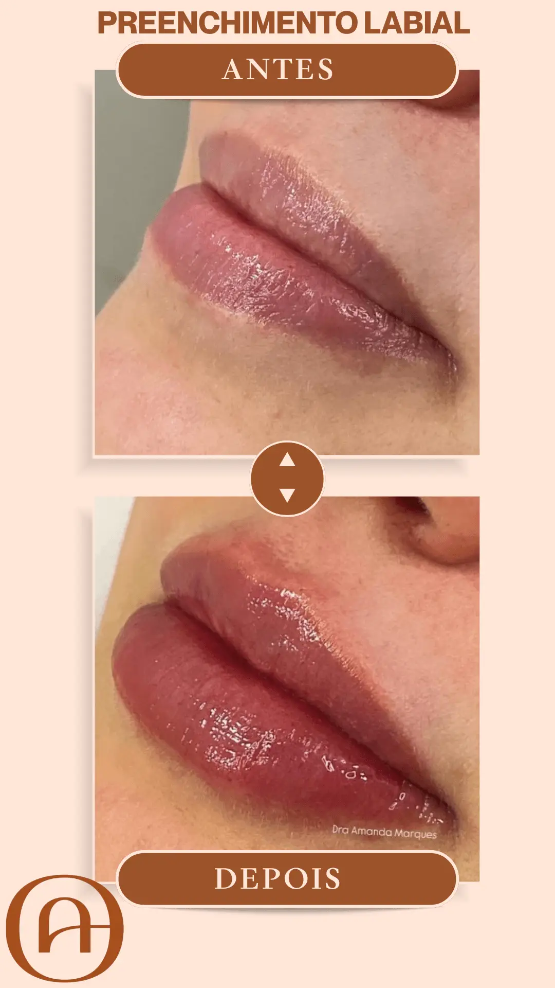 Realce sua beleza com preenchimento labial em Atibaia