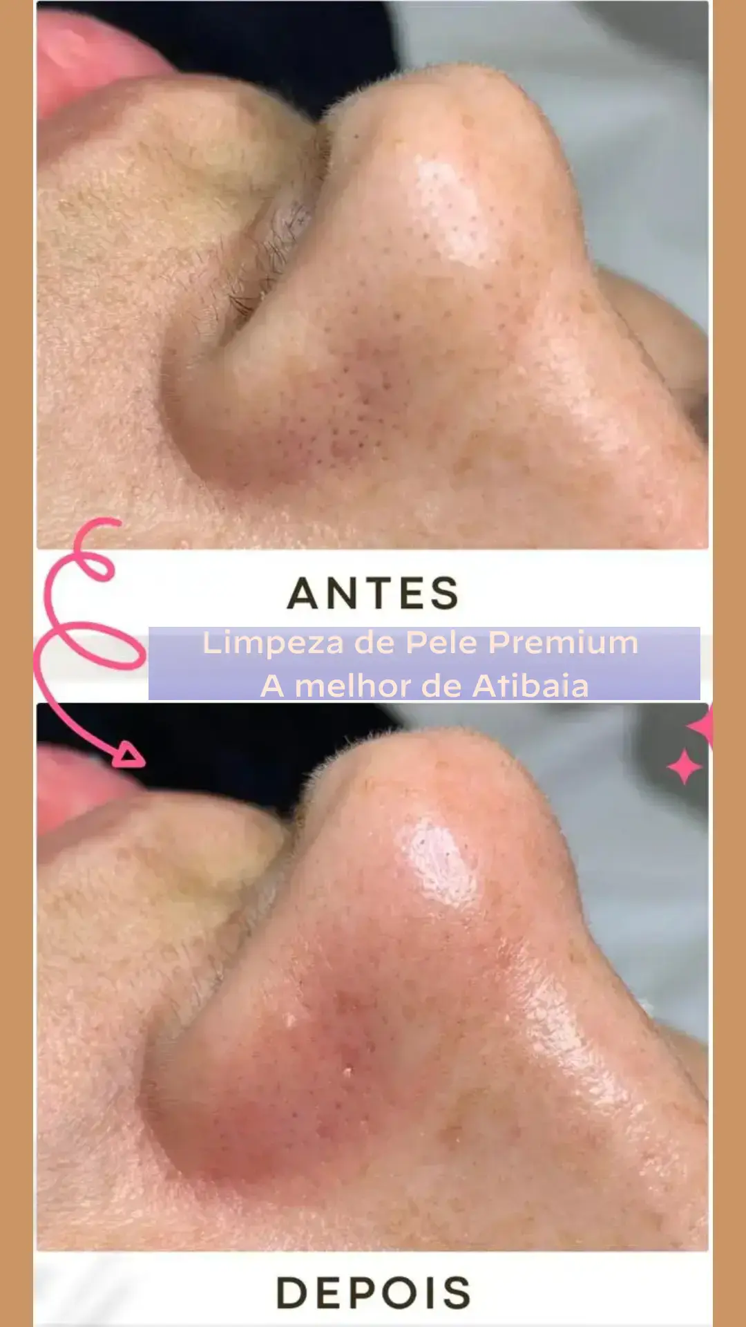 Cliente recebendo limpeza de pele premium na clínica Além do Olhar em Atibaia
