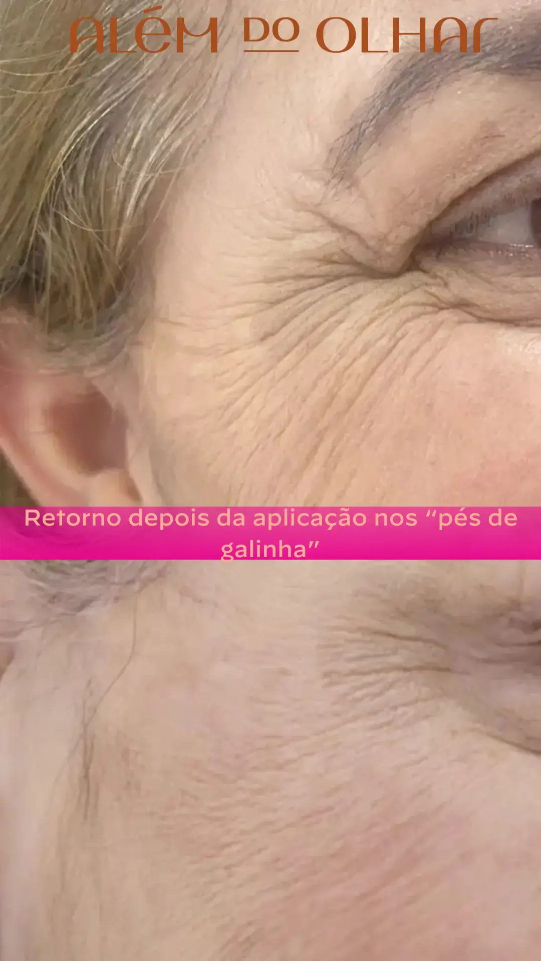 Close de um olhar feminino expressivo e suave, com a região dos olhos visivelmente rejuvenescida após aplicação do botox