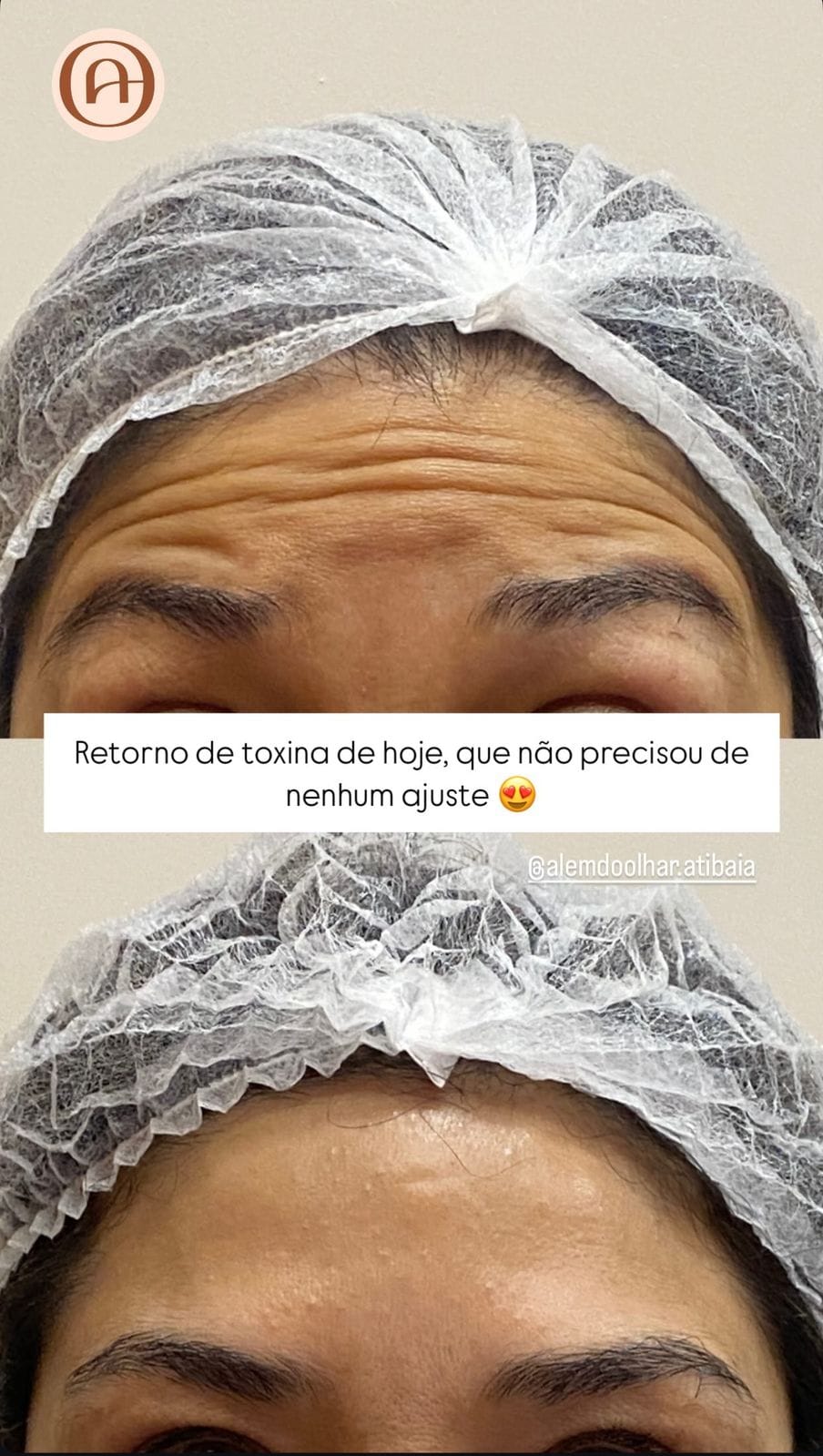 Previna e suavize linhas de expressão com o tratamento com botox feito por profissionais especializados na Além do Olhar Atibaia.